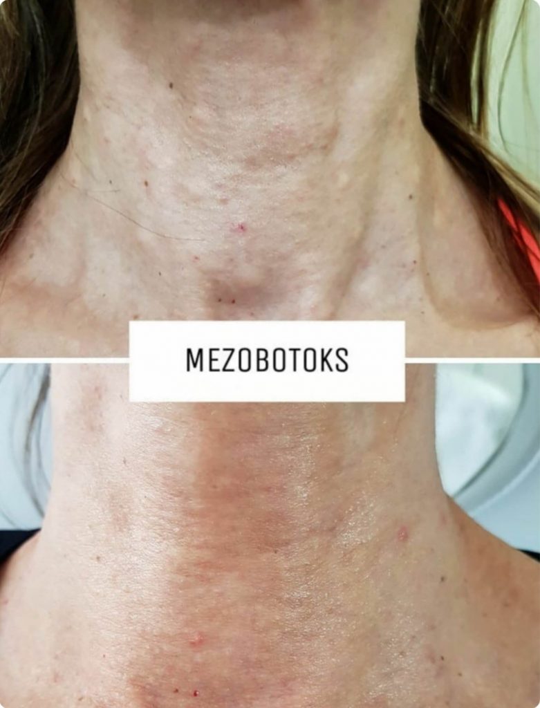 Dr Marija Bošković - Podmlađivanje vrata